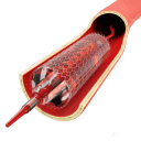 Angioplasty