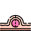 Epidermoid Cysts